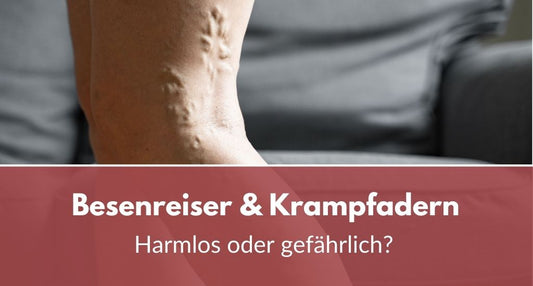 Besenreiser und Krampfadern gefährlich