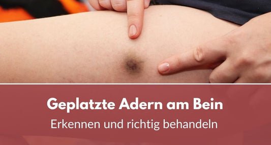 Geplatzte Ader am Bein