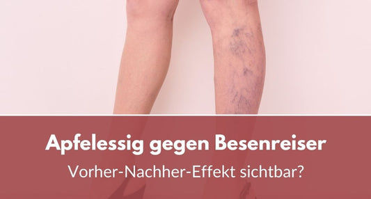 apfelessig gegen besenreiser